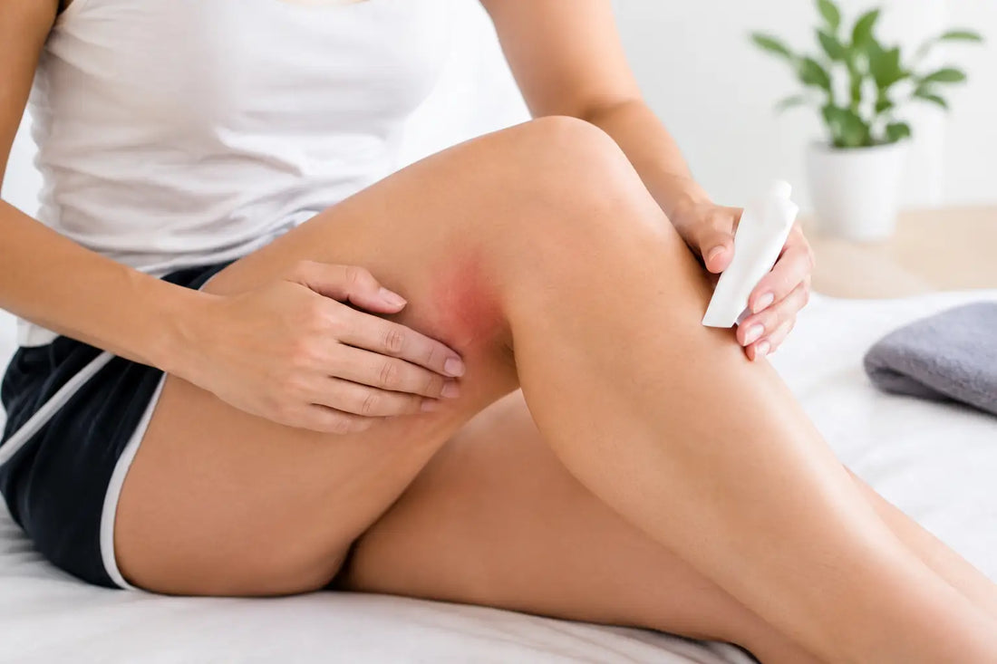 Qué hacer ante rozaduras para aliviar y prevenir
